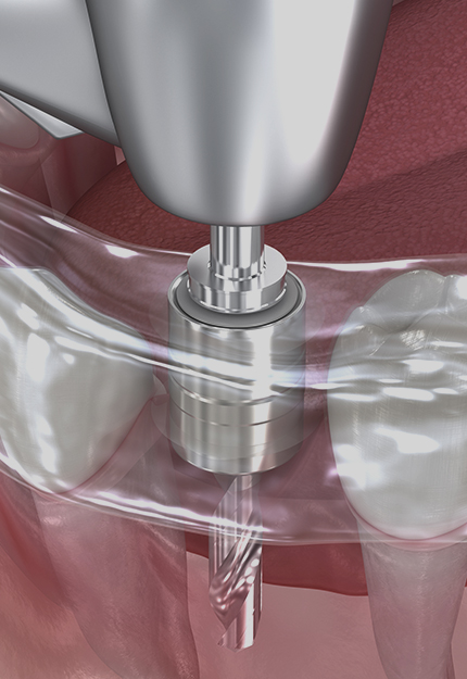 BITGARAM 임플란트